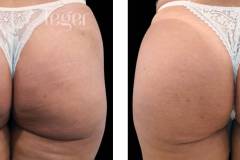 bioplastia-de-gluteos-antes-e-depois-clinica-leger-3