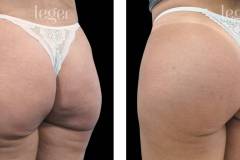 bioplastia-de-gluteos-antes-e-depois-clinica-leger-4