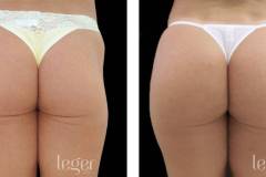 bioplastia-de-gluteos-antes-e-depois-clinica-leger-6