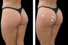 bioplastia-de-gluteos-antes-e-depois-clinica-leger-7