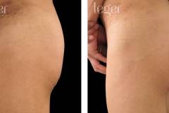 bioplastia-de-gluteos-antes-e-depois-clinica-leger-8