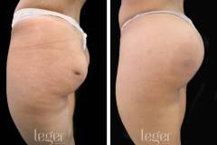 bioplastia-de-gluteos-antes-e-depois-clinica-leger