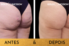 GoldIncision-elimina-celulite-inclusive-de-grandes-areas-achatadas-deixando-os-gluteos-lisinhos.2