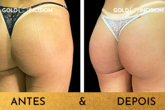 GoldIncision-elimina-celulite-inclusive-de-grandes-areas-achatadas-deixando-os-gluteos-lisinhos