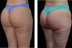 Goldincision-Celulite-Antes-e-Depois-