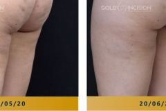 Goldincision-Celulite-Antes-e-Depois-2