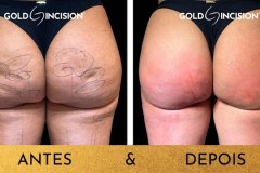 antes-e-depois-goldincision-celulite