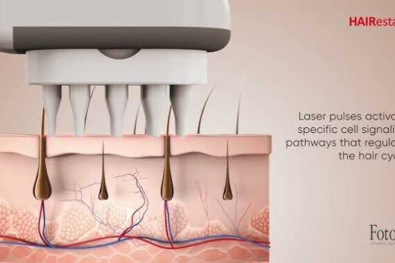 Imagem mostrando uma seção transversal da pele, incluindo folículos pilosos, onde um dispositivo aplica pulsos de laser ao couro cabeludo. O dispositivo possui múltiplos pontos que emitem pulsos de laser, estimulando os processos celulares da pele. Textos explicativos indicam que os pulsos de laser ativam vias de sinalização celular específicas que regulam o ciclo capilar. A imagem inclui marcações como \"HAIRRestart\" e \"Fotona choose perfection\".