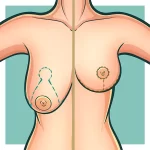 "Detalhe de uma pessoa recebendo avaliação médica, com foco no tórax, mostrando mãos enluvadas posicionadas cuidadosamente. Ambiente sugere um contexto clínico, relacionado a cirurgia ou exame médico.
