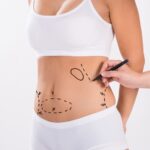 Mulher vestindo roupa íntima branca com marcações no abdômen feitas por profissional, indicando áreas para procedimento estético ou cirúrgico como lipoaspiração ou contorno corporal com BodyTite.