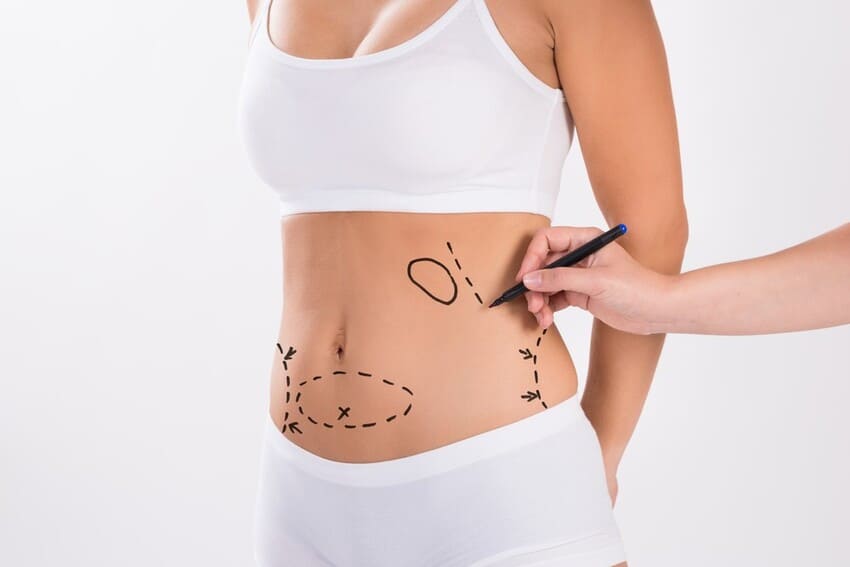 Mulher vestindo roupa íntima branca com marcações no abdômen feitas por profissional, indicando áreas para procedimento estético ou cirúrgico como lipoaspiração ou contorno corporal com BodyTite.